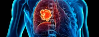 CÁNCER DE PULMÓN
