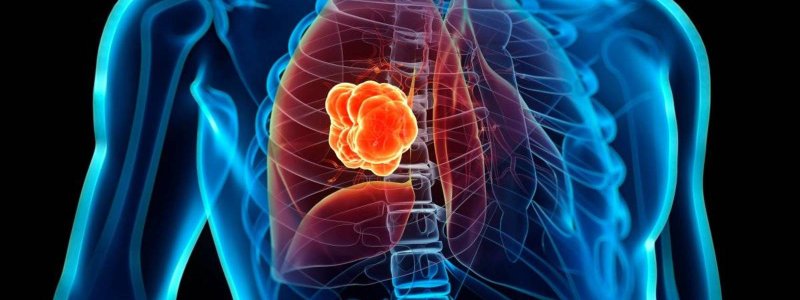 CÁNCER DE PULMÓN
