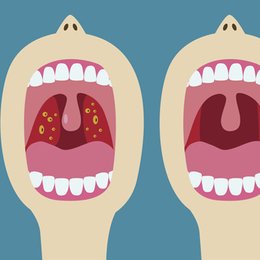 &iquest;C&oacute;mo se le llama a la inflamaci&oacute;n en las am&iacute;gdalas? - Terminolog&iacute;a M&eacute;dica.