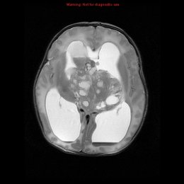 &iquest;Uno de los diagn&oacute;sticos diferenciales de esta neoplasia de la regi&oacute;n pineal es el teratoma, verdadero o falso? - Espa&ntilde;ol