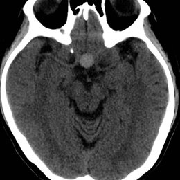 &iquest;Cu&aacute;l es el diagn&oacute;stico m&aacute;s probable de la siguiente imagen? - Espa&ntilde;ol