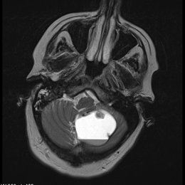 Esta neoplasia ocurre m&aacute;s frecuentemente en pacientes pedi&aacute;tricos y a nivel infratentorial. Se consideran tumores de grado I de la OMS en la clasificaci&oacute;n actual (2016) de la OMS de tumores del SNC. - Espa&ntilde;ol