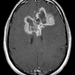 Neoplasia intracraneal primaria m&aacute;s com&uacute;n en adultos, en la clasificaci&oacute;n actual (2016) de la OMS de tumores del SNC , se reconocen tres variantes histol&oacute;gicas. - Espa&ntilde;ol