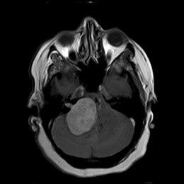 Son tumores relativamente comunes que surgen de los nervios craneales y representan 80% de las masas del &aacute;ngulo cerebellopontino, usualmente no presentan calcificaciones. - Espa&ntilde;ol