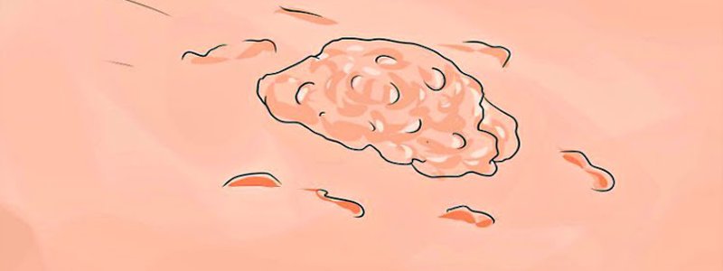 ¿Qué tanto conoces del Virus del Papiloma Humano (VPH)?.